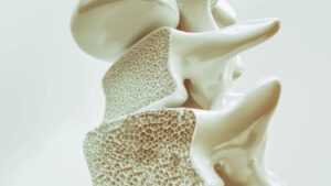 osteoporose-wirbelsaeule-3d-rendering-sanitaetshaus-wurst